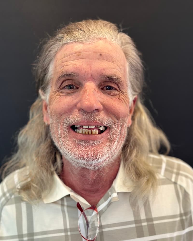 John before All-on-4 implants at Southern Smiles