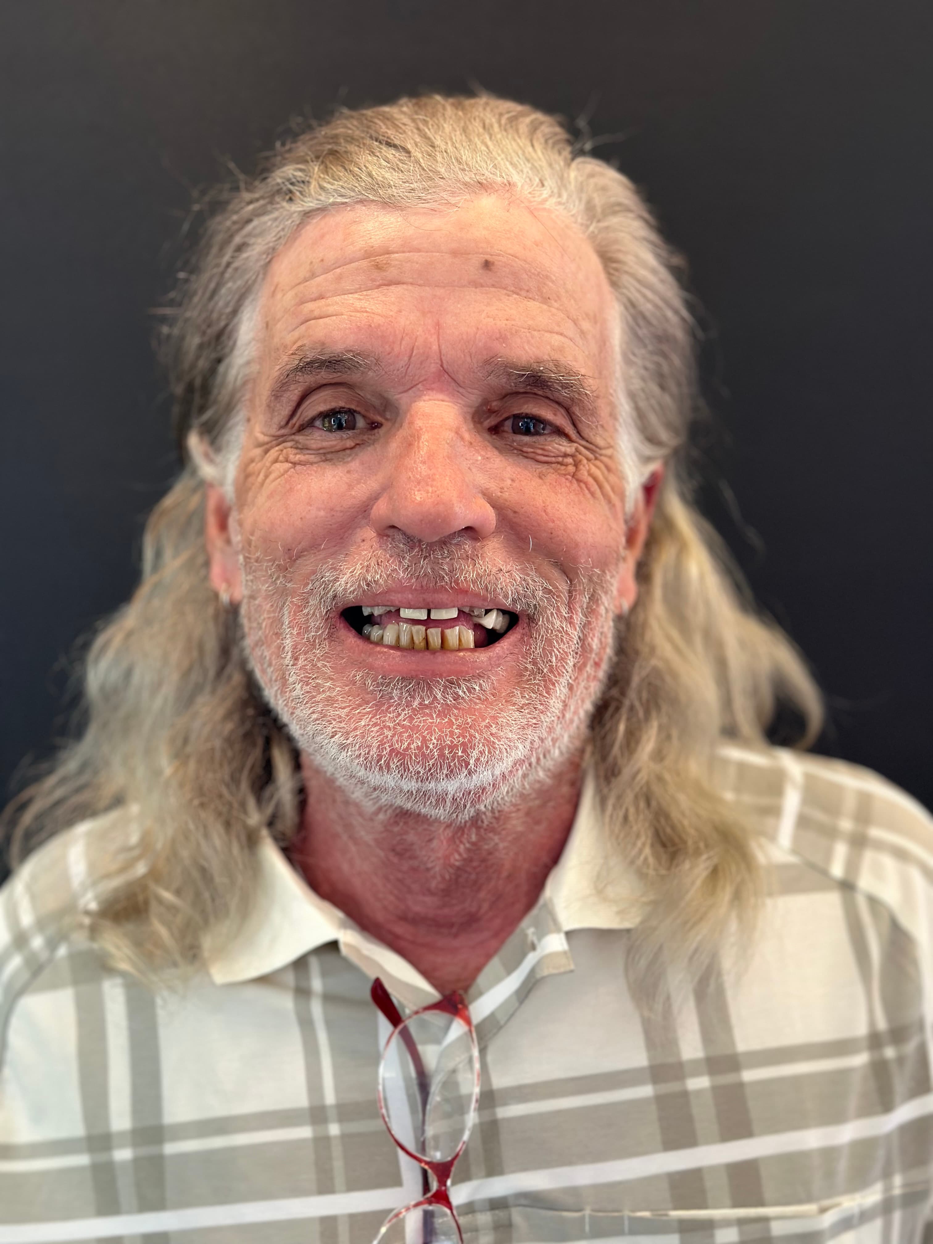 John before Fixed full-arch implants at Southern Smiles